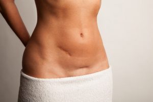 Lower abdomen where hernia is located